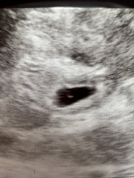 Twins at 5+3 or just my mind?!