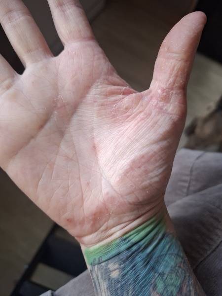 Hand infected (Warning, gross photos)