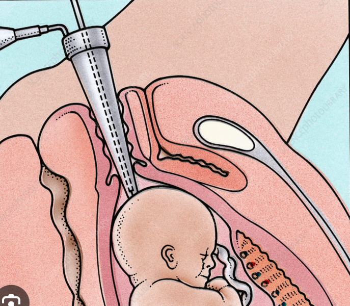 What was this instrument they used on me during birth?