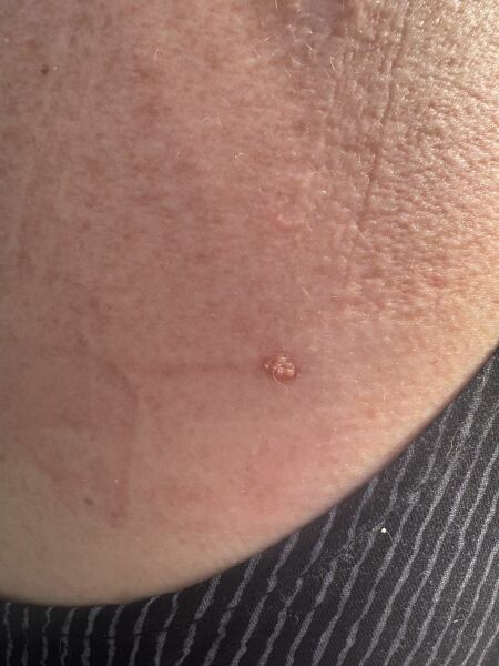 Does this mole look dodgy to you