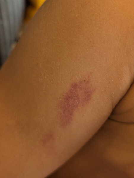 Night sweats and weird bruising