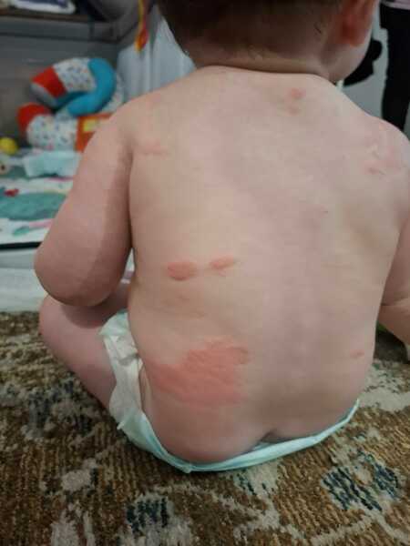 Eczema