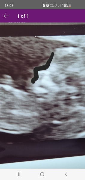 Is there a nasal bone present?