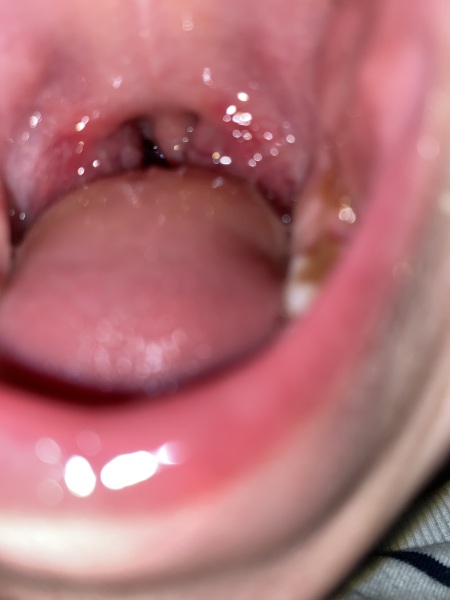 Persistant red swollen tonsils but no fever