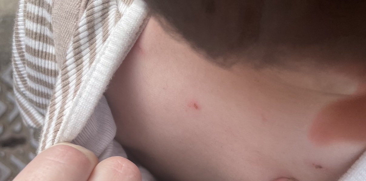 Help! Does this look like scabies?