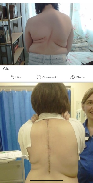 Is this scoliosis ? DD 17