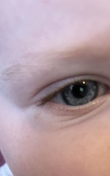 Brown mark on lower eyelid