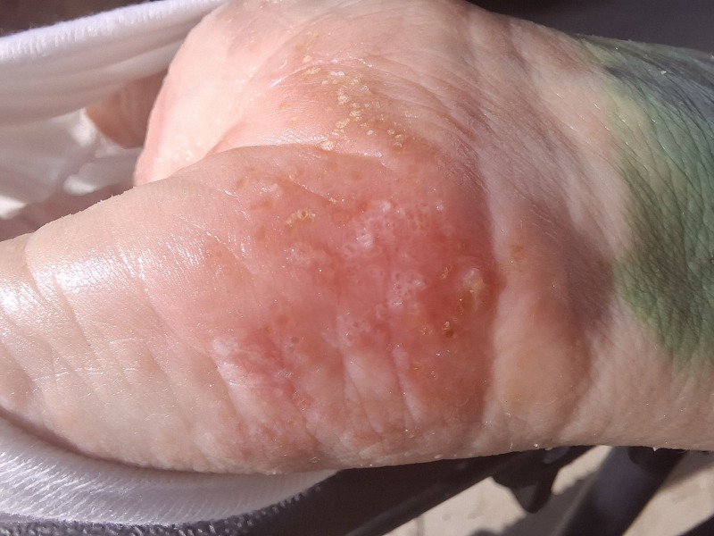 Hand infected (Warning, gross photos)