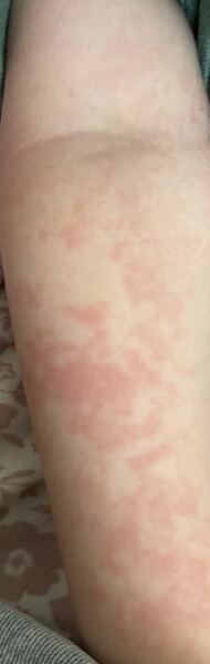 20 month old rash
