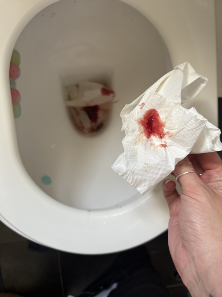 GRAPHIC PICS - Is this a miscarriage