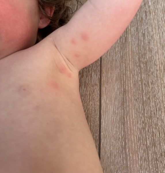 Rash advice on toddler (15 months)