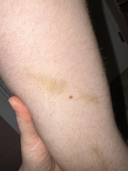 Should I get 4 year old’s mole checked?