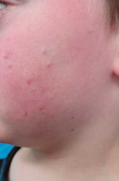 7 year old spots.