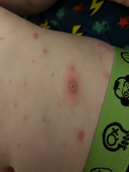 Infected chicken pox??