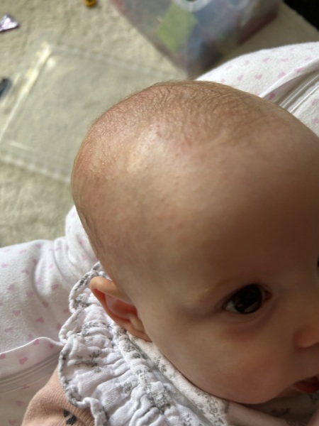 Four month old, is this eczema?