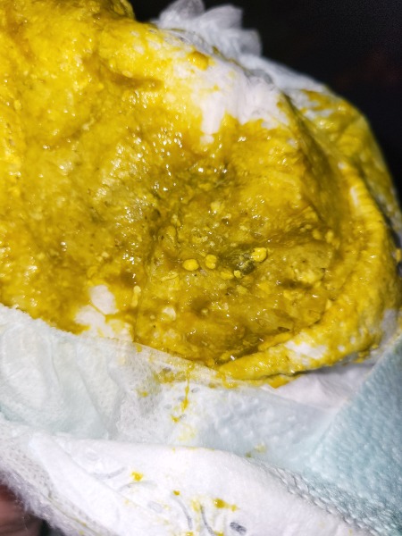 Teething poop or milk allergy??