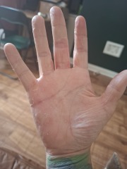 Hand infected (Warning, gross photos)