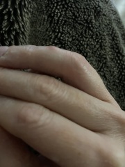 Spider bite?