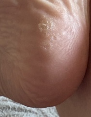 Foot problems
