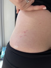 Shingles?