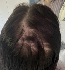 Am I balding