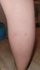 Help! Does this rash look familiar to anyone?