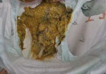 Teething poop or milk allergy??