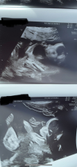 20 weeks gender prediction!