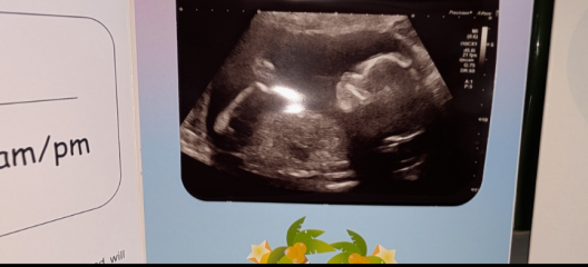 Incomplete 2nd 20 week scan