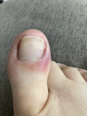 Is my toe infected? (Pictures)