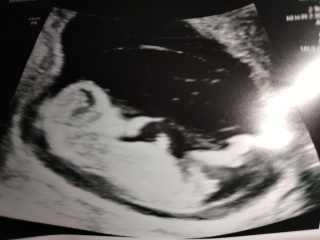 Nub/Gender from 12 week scan?