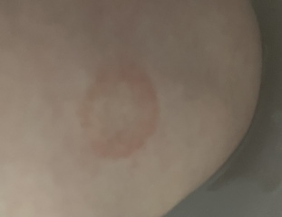 Ezcema or ring worm?