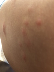 14yo has very bad rashes/bumps