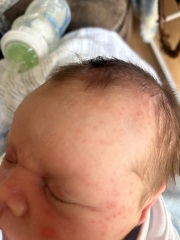 Baby acne or milk allergy.? Baby so upset after milk Pictures attached