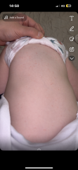 rash