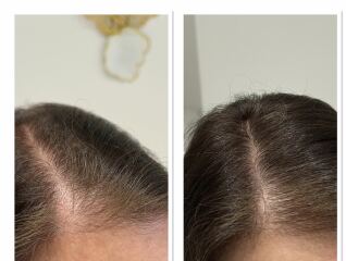 Female hair loss - please help