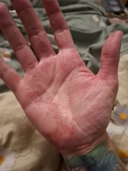 Hand infected (Warning, gross photos)