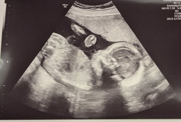 Is my baby a boy?