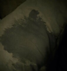 Night sweats and weird bruising