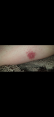 Is it Lyme?