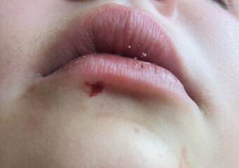 I think my DD has just bitten fully through her lip