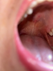 Any dentists about or GPs? Small hard lump roof of mouth