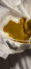 EBF nappy or allergy? Poo pics