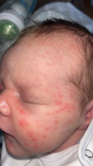 Baby acne or milk allergy.? Baby so upset after milk Pictures attached