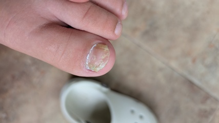 Fungal toenails, 8yo