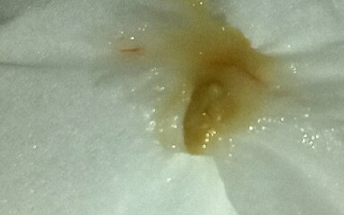 Can you blow a nasal polyp out? 