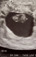 Can someone decipher my ultrasound please?