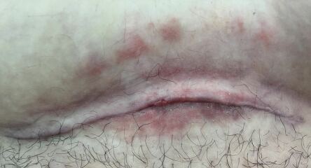 Infected c section??? *PICS*