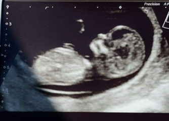 Sibling scan identical- same gender?