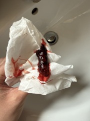 Is this a miscarriage? Or a SCH?